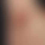 Hidradenitis suppurativa: chronically persistent, brownish or reddish livid scarring in the right...