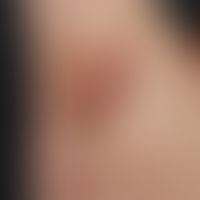 Hidradenitis suppurativa: chronisch persistierende, bräunlich oder rötlich livide Vernarbungen in...