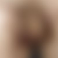 Hidradenitis suppurativa. Ausbildung eminent chronischer, abszedierender Fistelgänge mit inversem...