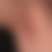 Hidradenitis suppurativa. Axillärer Befall.
