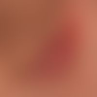 Hidradenitis suppurativa:&nbsp;axillärer Befall mit enzündlicher Knotenbildung.&nbsp;
