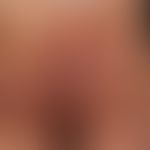 Hidradenitis suppurativa, grade III
