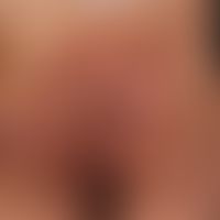 Hidradenitis suppurativa, grade III
