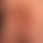 Hidradenitis suppurativa, a progressive and extensive finding with papules, pustules, nodules and...