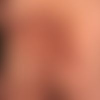 Hidradenitis suppurativa, a progressive and extensive finding with papules, pustules, nodules and...