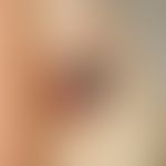 Hidradenom, noduläres. Umschriebener, deutlich das Hautniveau überragender Tumor mit fokaler Einb...