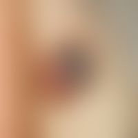 Hidradenoma, nodular tumor, clearly superior to the skin level with focal bleeding at the base, b...