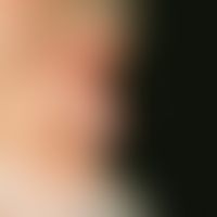 Hidradenoma, nodular, slowly growing, skin-coloured tumour below the lower lip, which is clearly ...