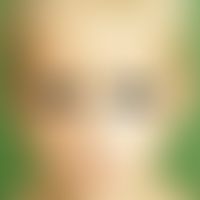 Hidroa vacciniformia: Large blisters and crusts in the area of the face in an 8-year-old boy afte...