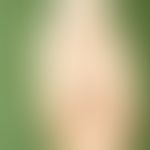 Hidroa vacciniformia. large, subepidermal, water-clear, occasionally also hemorrhagic blisters on...