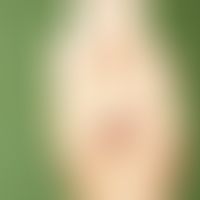 Hidroa vacciniformia. large, subepidermal, water-clear, occasionally also hemorrhagic blisters on...
