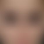 Hidroa vacciniformia. occurrence of small vesicles in the region of the bridge of the nose in an ...