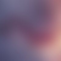 Hidroacanthoma simplex. reflected light microscopy (section): Strongly dilated, S-shaped vessel i...
