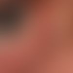 Hidrozystom, apokrines. Bemerkung: Die solitären Zysten des Lidrandes werden eher als apokrine Zy...
