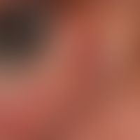 Hidrozystom, apokrines. Bemerkung: Die solitären Zysten des Lidrandes werden eher als apokrine Zy...
