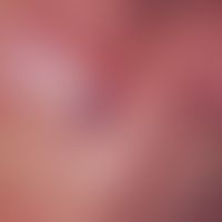 Hidrocystoma, eccrine. solitary, round, symptom-free, blue papule of the infraorbital region slig...