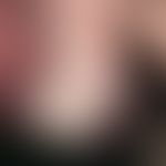 Hirsuties papillaris penis. Es bestehen bei dem 45-jährigen Mann reihenförmig angeordnete, chroni...