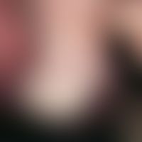 Hirsuties papillaris penis. 45-year-old man has rows of chronically stationary papillary or filif...