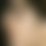Hirsutismus. Ausgeprägte Gesichtsbehaarung bei zwanzigjähriger Frau.

