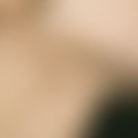 Hirsutismus. Detailaufnahme im Bereich des Bartes und Halses.