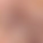 Hirsutismus. Auflichtmikroskopie: Kinnbereich einer 56-jährigen Frau mit endokrinem Hirsutismus. ...