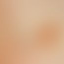 Dermatofibroma. A coarse, reddish-brownish tumour, raised flat above the skin level.