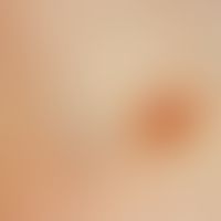 Dermatofibrom. Derber, rotbräunlicher, flach über das Hautniveau erhabener Tumor.