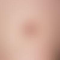 Dermatofibroma: a coarse tumour with pigmented edges that protrudes above the skin level.
