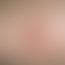 Histiocytoma, malignant fibrous, painless, plate-like, coarse, reddish-brown nodules, centrally c...
