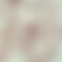 Histoplasmose, afrikanische. Übersichtsaufnahme: Histoplasma capsulatum var. duboisii; Lymphknote...