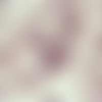 Histoplasmose, afrikanische. Detailvergrößerung: Histoplasma capsulatum var. duboisii; (Lymphknot...