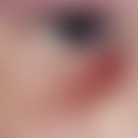 Hordeolum. solitary, acute (existing since 7 days), 0.5 cm high, bulging, strongly painful, red, ...