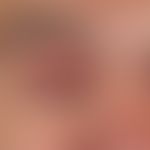 Hordeolum. solitary, acute (existing for a few days), 0.5 cm high, bulging, considerably painful,...