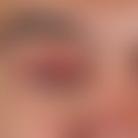 Hordeolum. solitary, acute (existing for a few days), 0.5 cm high, bulging, considerably painful,...