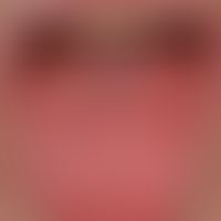 Lipoidproteinose (Hyalinosis cutis et mucosae): Detailaufnahme: hervortetende Zungenpapillen, die...