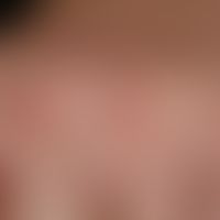 Hyalinosis cutis et mucosae: Chronically stationary, persistent, no longer increasing, red to yel...