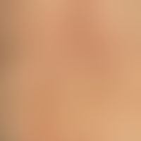 Dermatitis, hypereosinophilic. partly papular, partly plaque-like, considerably itchy exanthema o...
