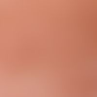 Hyperhidrosis pedum et manuum. reflected light microscopy (without contact medium): Hand of a 23-...