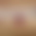 Hyperkeratosis follicularis et parafollicularis in cutem penetrans. Solitäre, bräunlich-rote Pape...