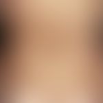 Hyperpigmentation, caloric. 55-year-old female patient, who was treated for several months with h...