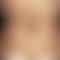Hyperpigmentation, caloric. 55-year-old female patient, who was treated for several months with h...