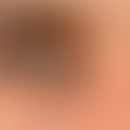 Hyperpigmentation, postinflammatory. sharply limited brownish spot in the area of the medial inne...