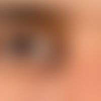 Hyperpigmentierung, postinflammatorische. Scharf begrenzter, bräunlicher Fleck im Bereich des med...
