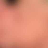 Hyperpigmentierung, postinflammatorische. Flächige, bräunliche Hyperpigmentierung im Gesicht eine...