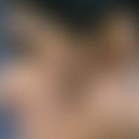 Hyperpigmentierung, postinflammatorische. Multiple, an beiden Wangen lokalisierte, chronisch stat...