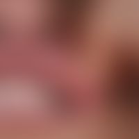 Hyperplasia, focal epithelial. In the 34-year-old Turkish patient, several flat papules have been...