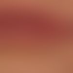 Hyperplasie, fokale epitheliale (Morbus Heck)
