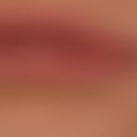 Hyperplasia, focal epithelial (Heck's disease)
