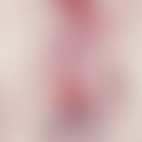 Hypertrichose. Histologisches Bild nach gezielter Zerstörung der Haarwurzel mittels Laser-Therapie.