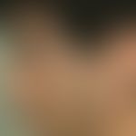 hypertrichosis, acquired circumscript. hypertrichosis on both cheeks increasing since 2 years, in...